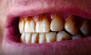 How long for gums to heal after quitting smoking?