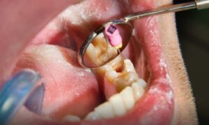 Symptoms Of A Tooth Infection Spreading To The Body