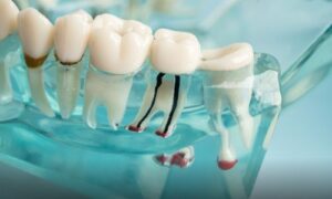 Most Common Types of Dental Emergencies