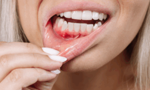 after tooth extraction