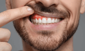 abscess pimple on gum