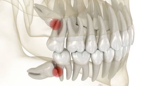 This article discusses bone shards that may be found after the extraction of a wisdom tooth. We'll discuss the nature of these conditions,