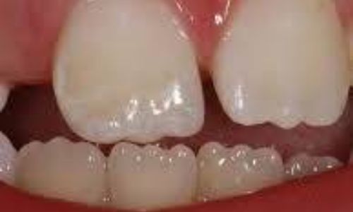 In this article, we'll delve into what mamelon teeth are, why they form, and whether they require any special attention.