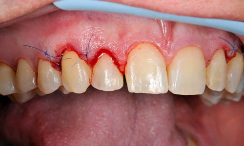 Understanding Dissolvable Stitches in Mouth