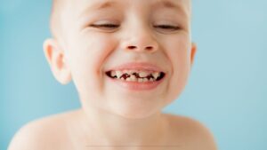 dental sealants for kids