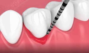 periodontal disease treatment options