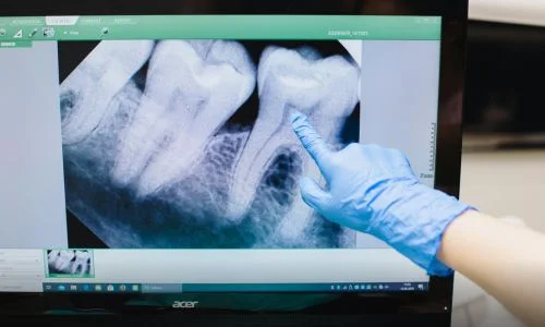 How do I avoid the need for “dental work”??