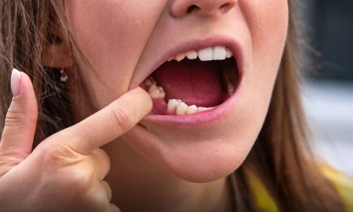 Tooth Bonding: Maybe you need a mini-Makeover?