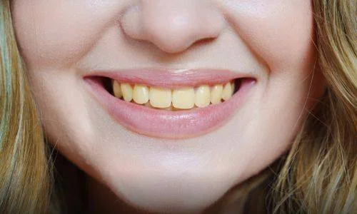 Tooth discoloration what you need to know