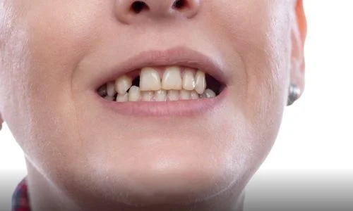 How To Save A Damaged Tooth