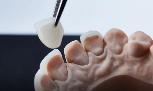 Dental Crowns