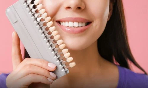 Veneers
