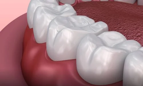 Dental Sealants
