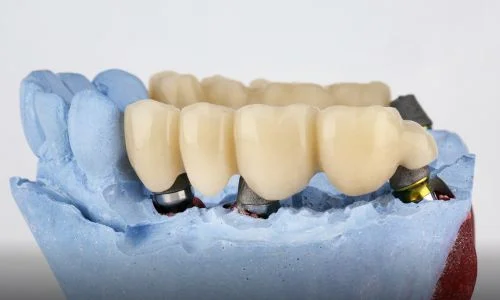 Types of Dental Bridge Materials