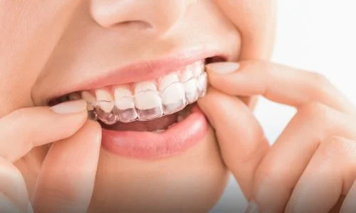 Invisalign treatment