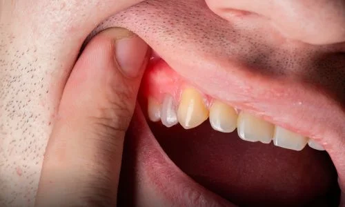 Gum Diseases