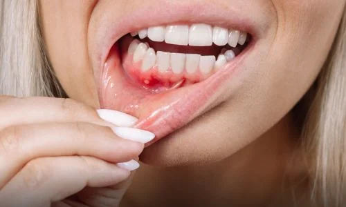 Gingivitis vs. Periodontitis