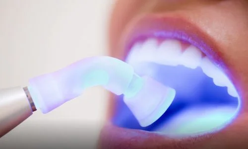 dental laser therapy
