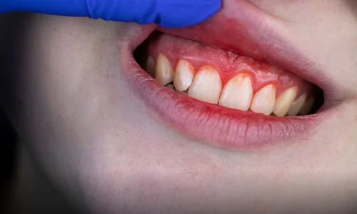 Gum Disease