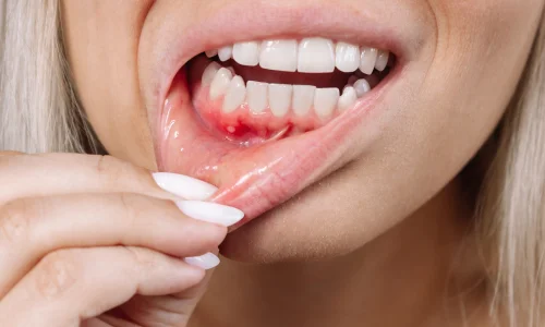 after tooth extraction