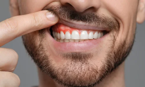 abscess pimple on gum