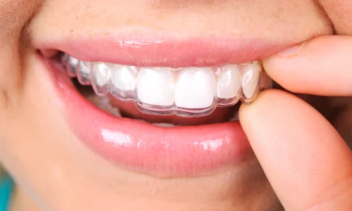 retainer dental cost