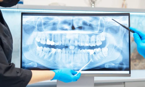 Xrays