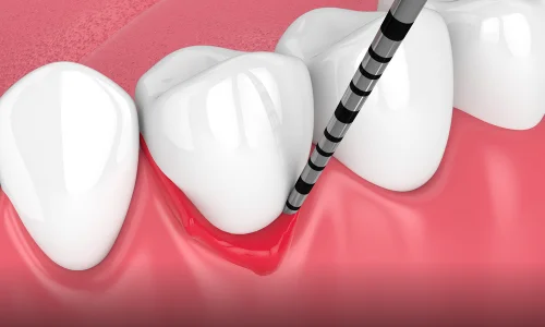 periodontal disease treatment options