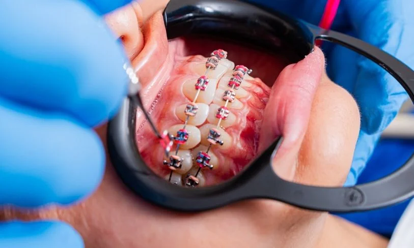 early orthodontic spacers