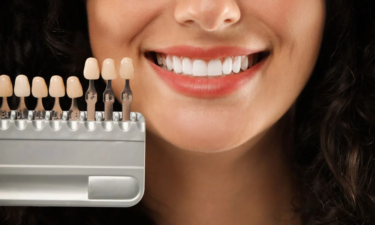 Bonding vs. Veneers