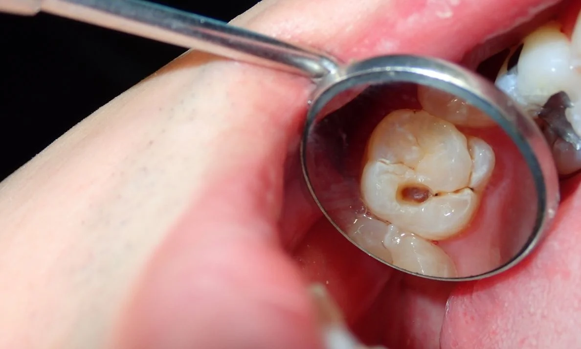 reverse early cavities