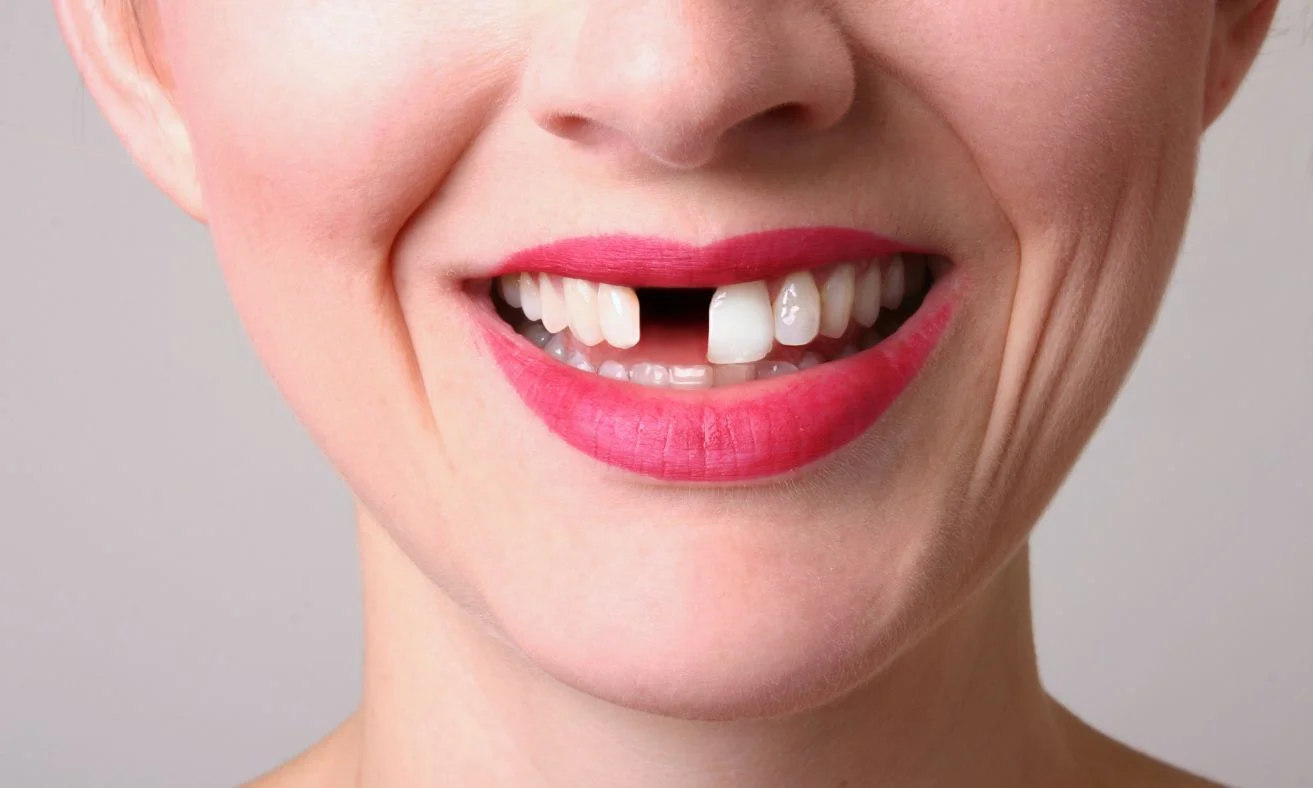 impact of missing teeth