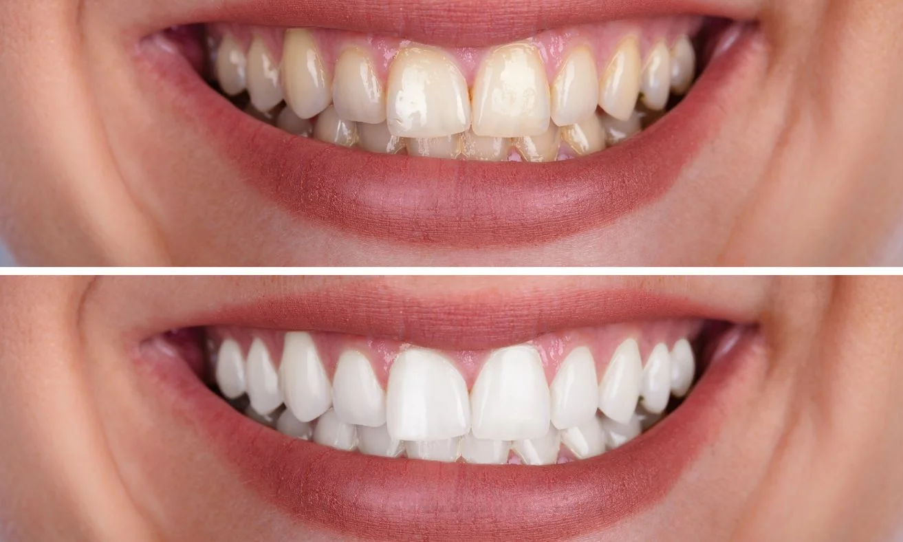 whitening vs brightening teeth