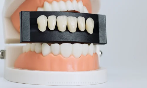 dental veneers