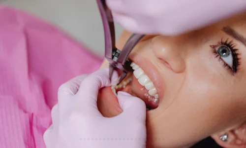 old dental fillings
