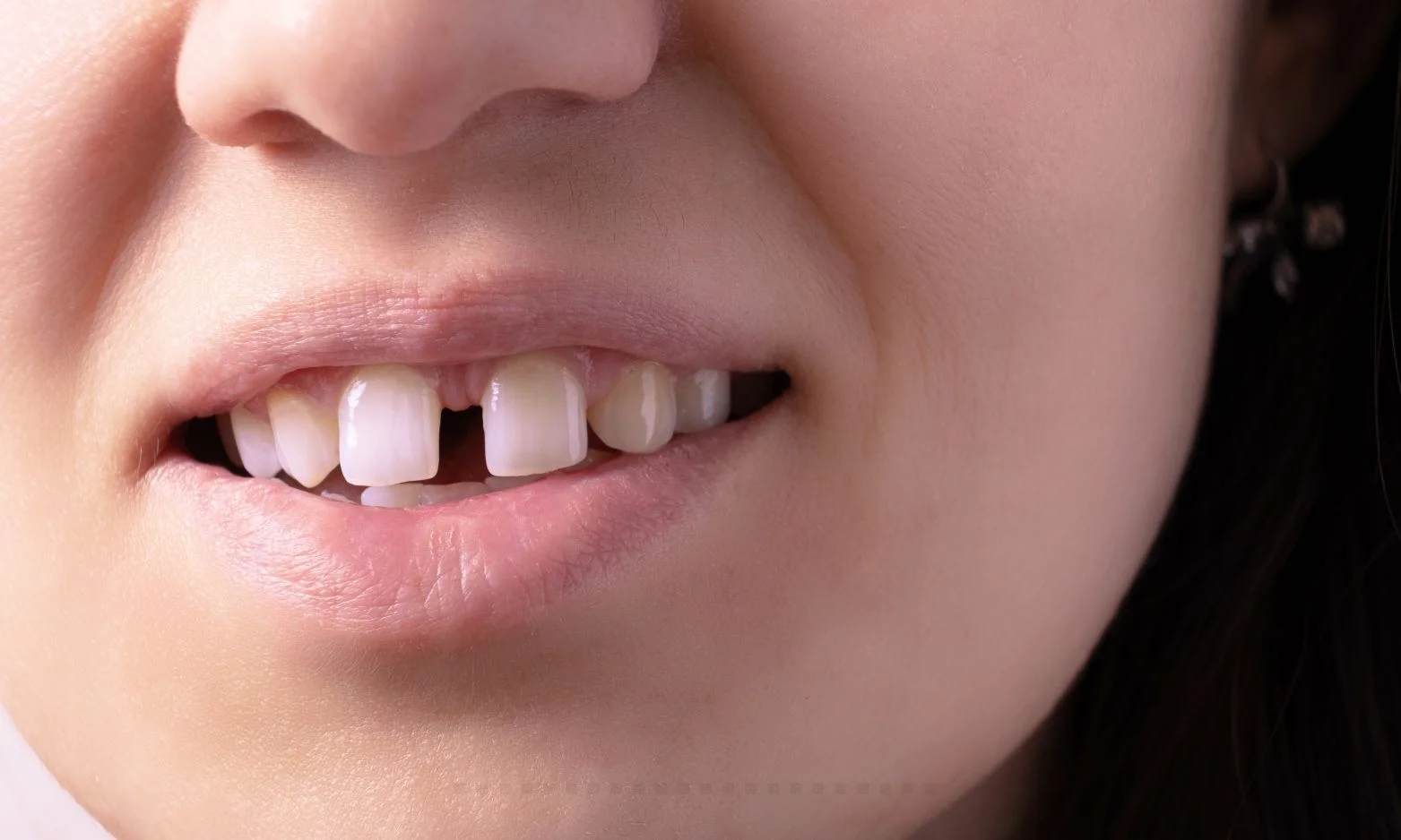 teeth gaps