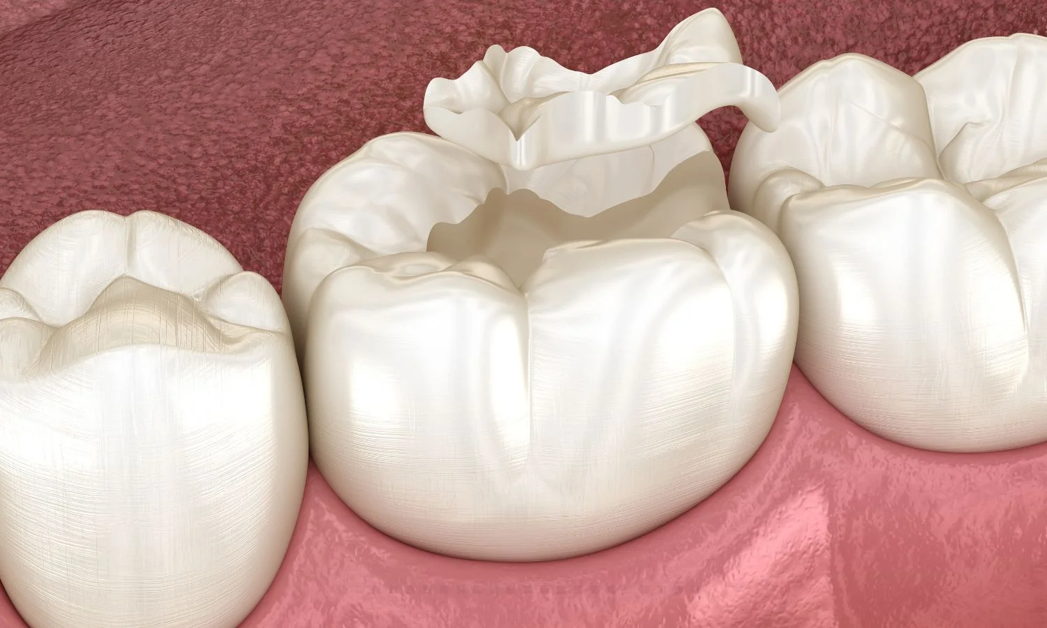 cracked tooth