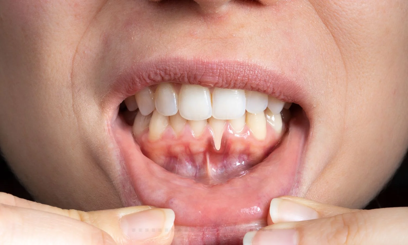 Gum Recession