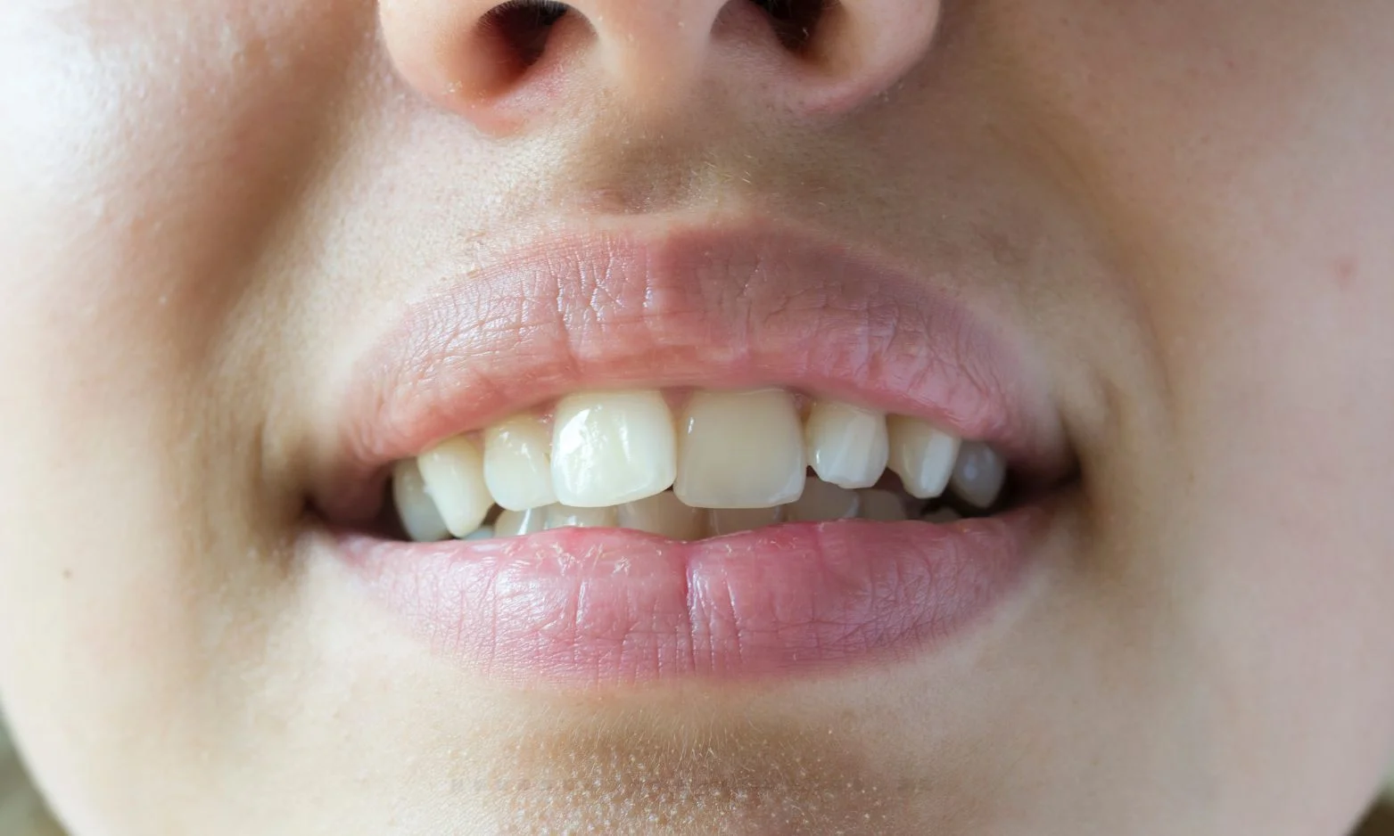 crooked teeth